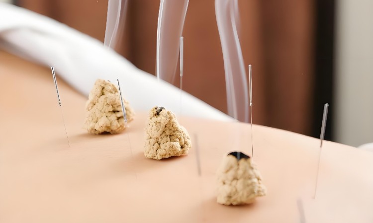 省级公立医院艾灸培训班